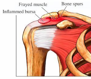 Most shoulder problems involve the muscles, ligaments and tendons, rather than the bones. These problems fall into three categories: 1. Tendonitis/Tendonosis/Bursitis 2. Injury/Instability 3.