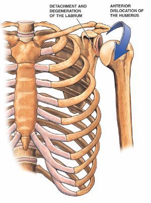 INSTABILITY/INJURY Shoulder instability either occurs due to a direct trauma causing a dislocation of the joint, or as a result of weakness in the rotator cuff muscles causing slackness with