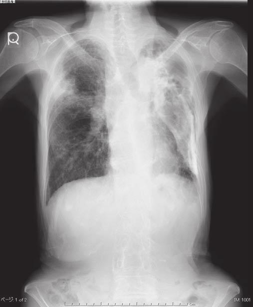 374 Makoto HAYASHI, et al A B Fig. 1. Radiographic examinations at the time of presentation. A Chest X-ray showed bronchiectasis and infiltration in the right middle lung field.