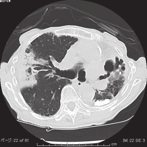 B Chest computed tomography showed consolidation and bronchiectasis in the right S3.