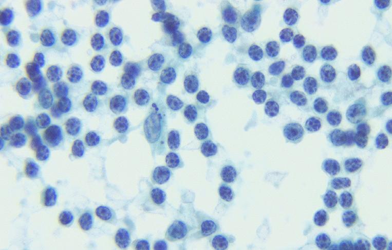 Small lymphocytic lymphoma Image 7: Papanicolaou stained smear, 100x.