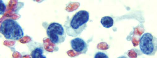 Papanicolaou stain, 100x Differential diagnosis Marginal Zone lymphoma Image 15: