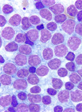 Mantle cell lymphoma Image 17: The classic variant of mantle cell lymphoma is composed of small,