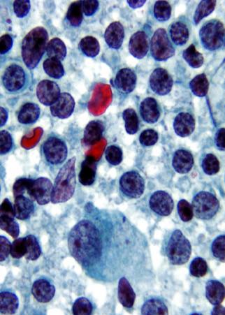 normal lymphocytes, and inconspicuous nucleoli.
