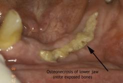5mg po daily 3mg IV q3 months Esophagitis Myalgias Osteonecrosis of jaw Same as above Same as above Flu-like symptoms Jaw bone (osteo-) damage and death (-necrosis) occurs as a result of