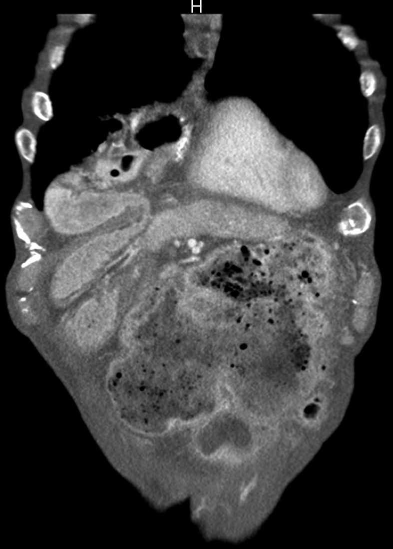 Weiss ARR et al. Ileo-right hemi-colonic cervical pull-up Figure 3 Largely dilated cecum in the upper abdomen.