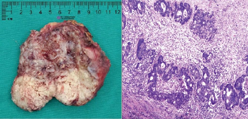 Liu YY et al. Adrenal metastasis from colorectal adenocarcinoma A B Figure 2 Adrenal tumor.