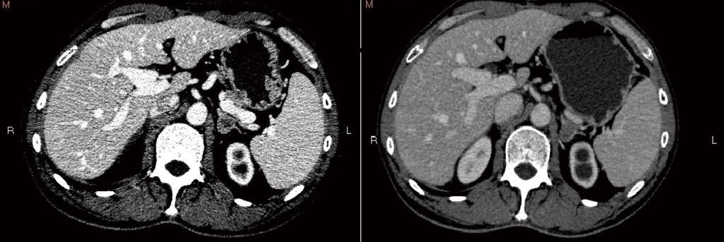 primary sigmoid lesion that had been resected. This indicated that the metastasis was from the sigmoid carcinoma. A B Figure 3 Computed tomography image.