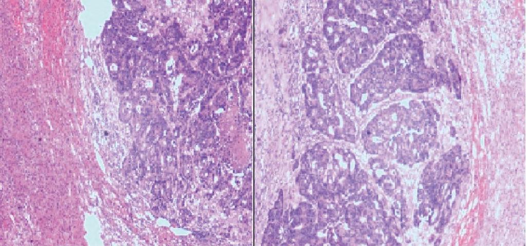 Figure 4 Pathological findings of the left adrenal tumor showed moderately differentiated adenocarcinoma, compatible with metastasis from the rectal carcinoma.