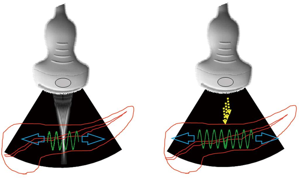 Kawada N et al. Elastography for the pancreas Acoustic radiation force impulse Shear wave Figure 1 Measurement principle of shear wave elastography.