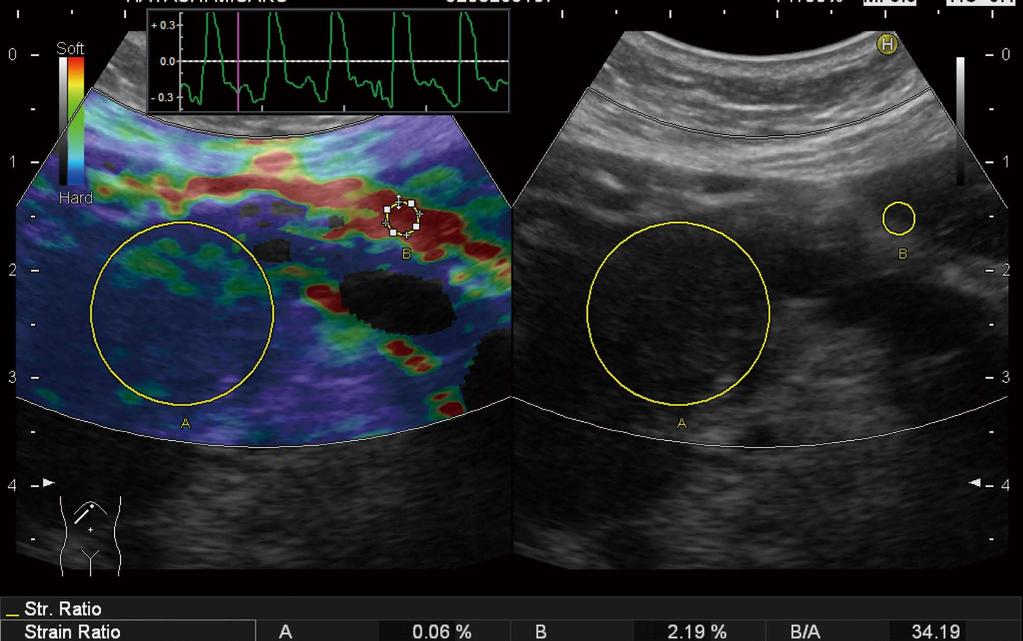 Kawada N et al. Elastography for the pancreas Figure 3 Quantitative diagnosis in US-Real-time Tissue Elastography TM. A hypoechoic tumor is seen at the pancreatic tail in B-mode (right).