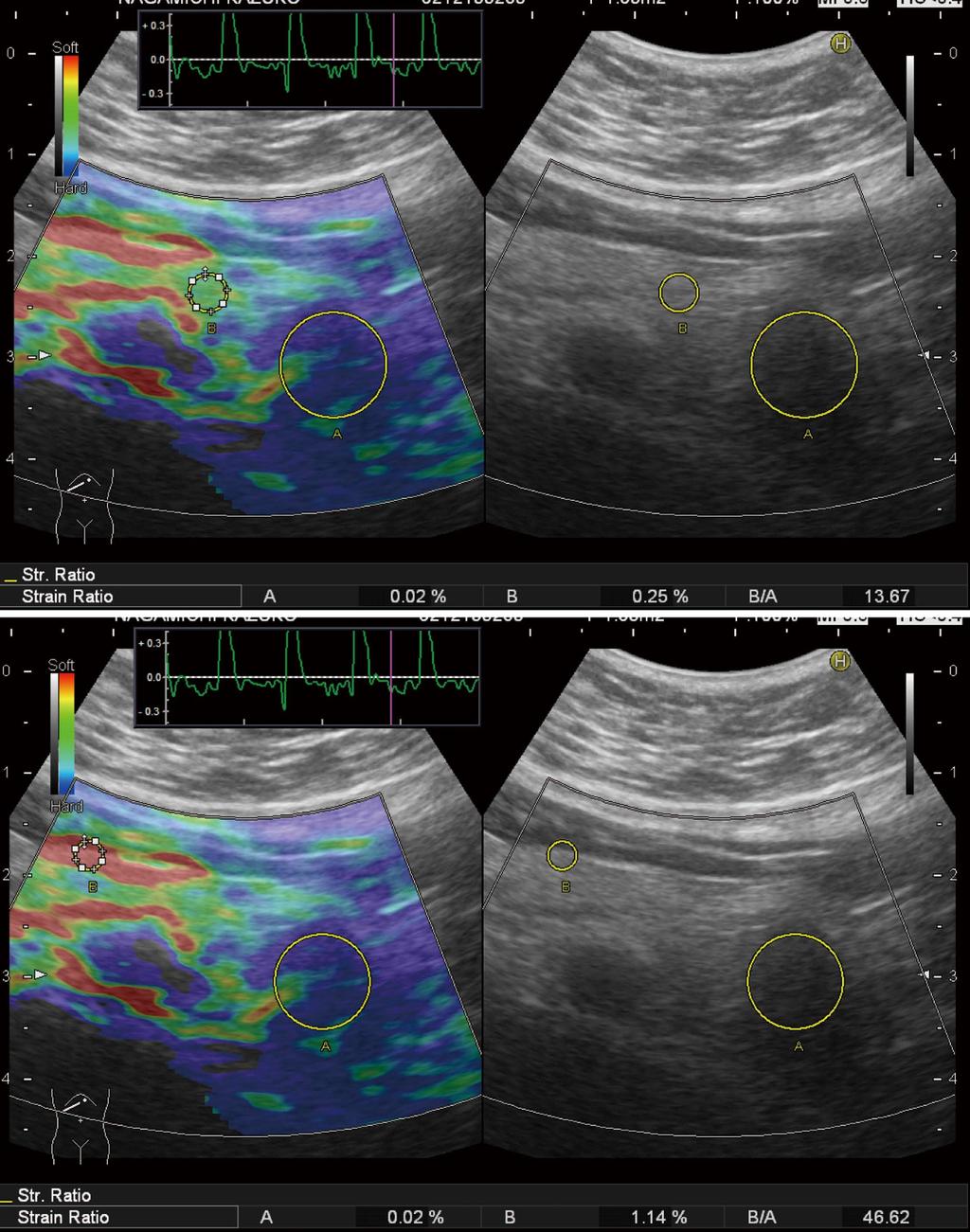 Kawada N et al. Elastography for the pancreas Figure 4 Setting the different reference area in a case of pancreatic tail tumor.