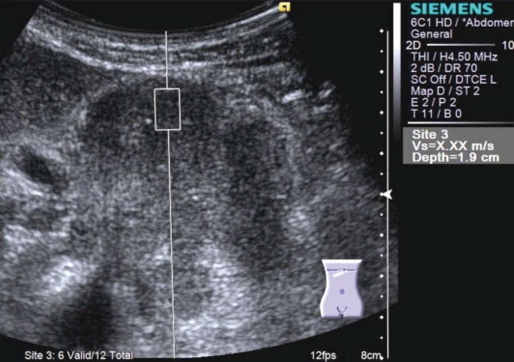 Figure 8 Virtual Touch TM Quantification (Siemens) performed for a large tumor at the pancreatic body. Shear wave velocity cannot be measured because the tumor is too hard.