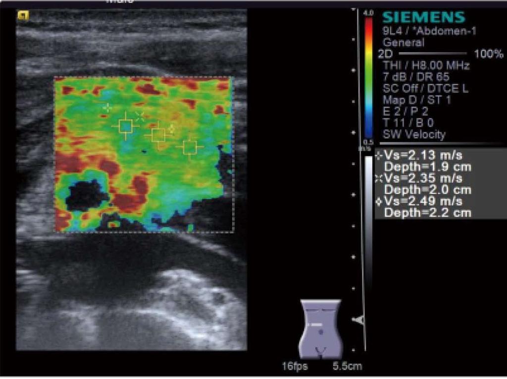 Kawada N et al. Elastography for the pancreas A B Figure 9 Virtual Touch TM IQ (Siemens) performed for a pancreatic body tumor.