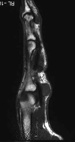 Fig. 1: A T1-weighted MR image shows three, hypointense lesions in the volar aspect of the right index finger, attaching to the flexor tendon.