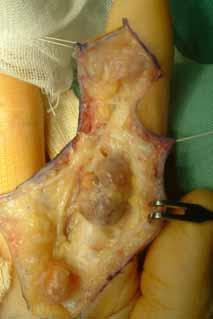 The tumor around the MP joint was yellow, and the tumors around the PIP and DIP joints were yellow to mottled brown in color.