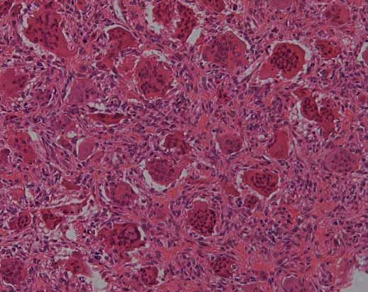 Fig. 5: Histologic specimens obtained from the rib consist of numerous multinucleated giant cells and benign spindle-shaped stromal cells Specimens obtained from the right fibula show similar