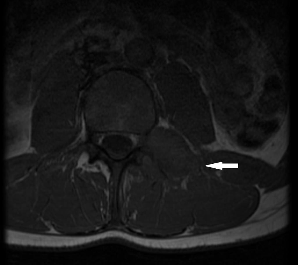 Fig. 4: Axial T1-weighted image shows an isointense mass located in the left transverse apophysis, pedicle and superior