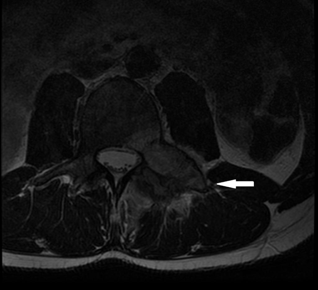 Fig. 6: Axial T2-weighted image shows a hyperintense mass located in the left transverse apophysis, pedicle and superior