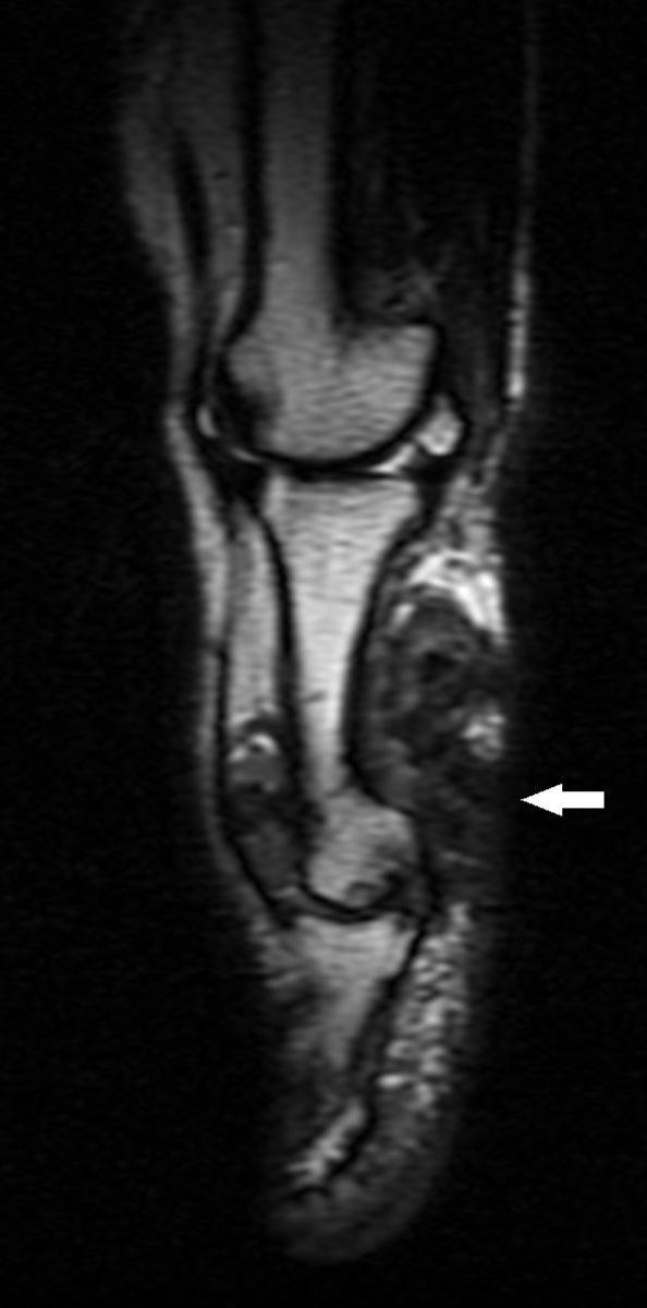 Fig. 11: Giant cell tumor of the tendon sheath in the first finger of a 69-year-old woman.