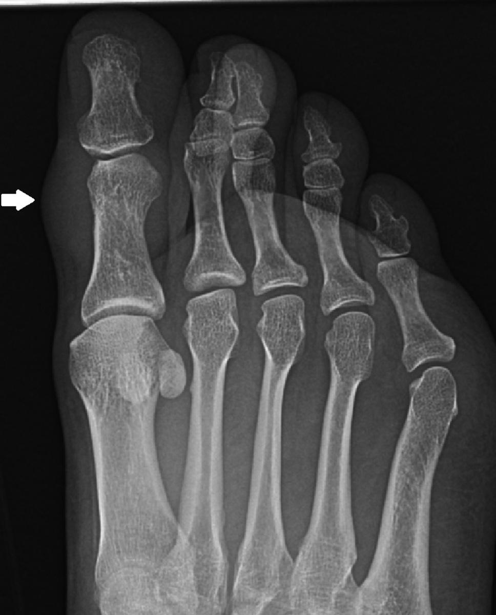 Fig. 12: 38-year-old woman with a soft tissue mass in the great toe of the right foot.