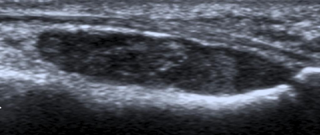 Fig. 13: 38-year-old woman with a soft tissue mass in the great toe of the right foot. Ultrasonographic image shows a fusiform hypoechogenic mass in relationship with the extensor digitorum longus.