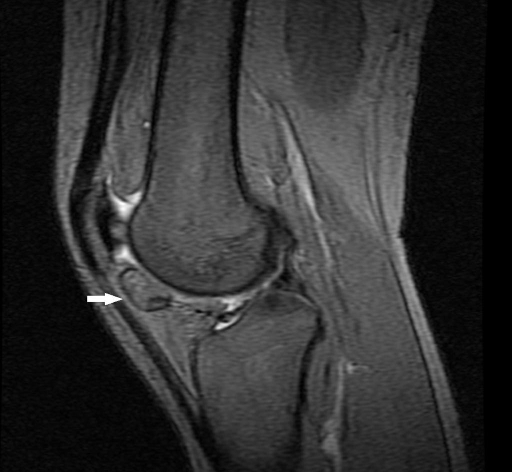 Fig. 15: 38-year-old woman with a giant cell tumor of the tendon sheath in the great toe of the right foot.