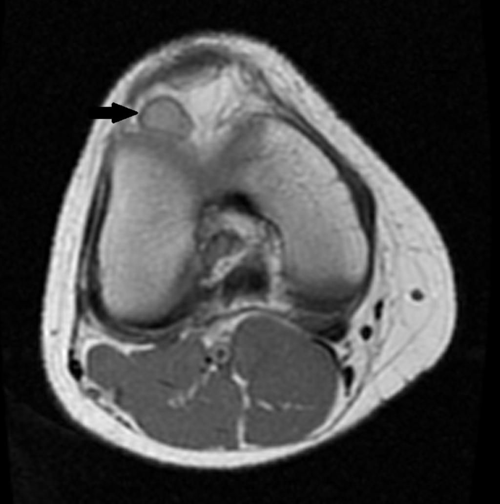 Fig. 19: 20-year-old woman who presents a soft tissue mass in the right knee.
