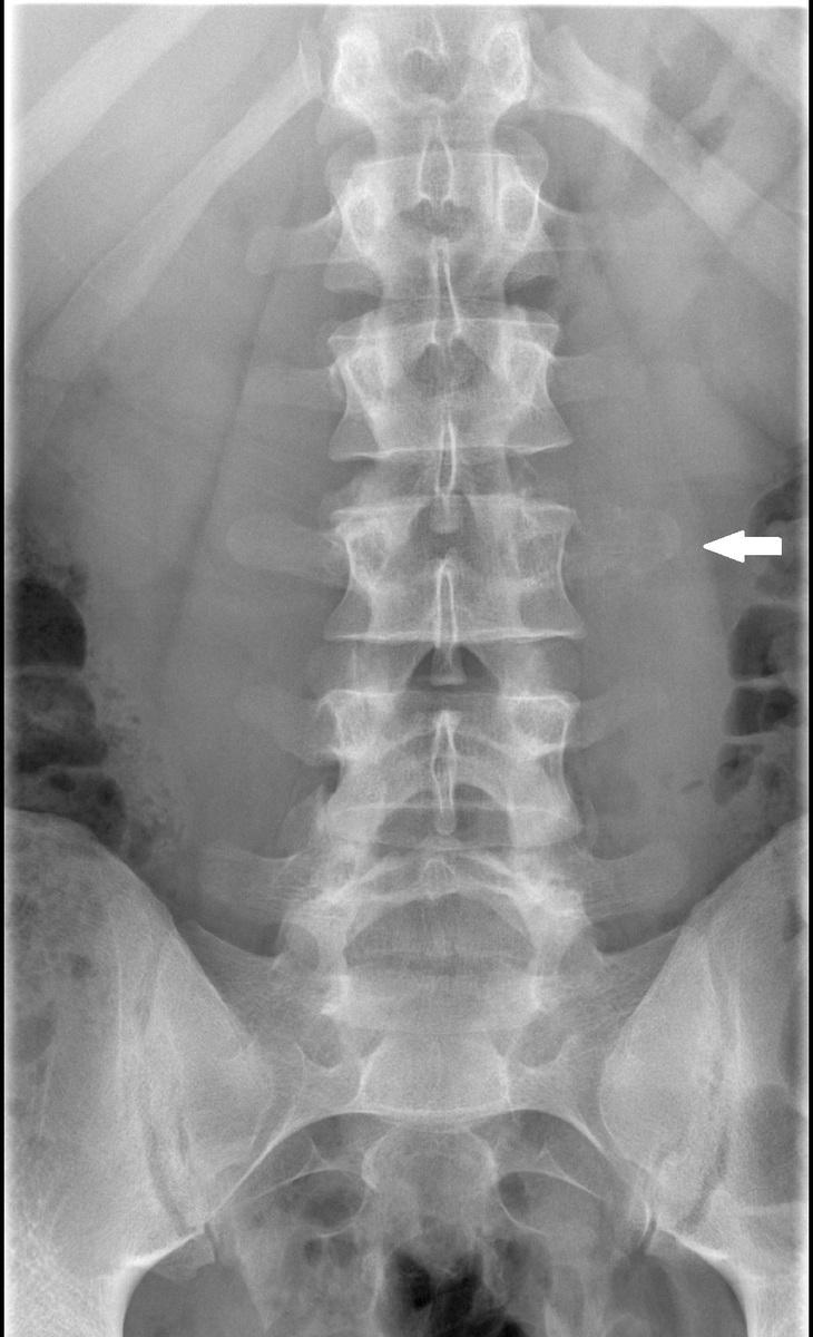 Fig. 2: Lumbosacral radiography shows an expansive lytic lesion in the left transverse apophysis of the