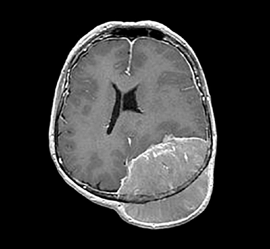 Figure 1. MRI of the brain with gadolinium: Axial T1W sequence showing a large left parietal extra-axial diffusely enhancing mass with edema and mass effect on the brain.