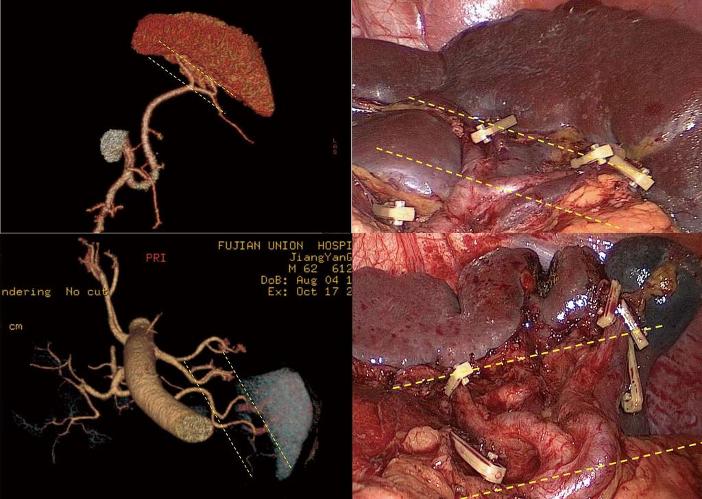 Zheng CH et al. Vascular anatomy in splenic hilum A 1 2 < 2.0 cm < 2.0 cm B 1 2 2.0 cm 2.0 cm Figure 1 terminal branches of the splenic artery.