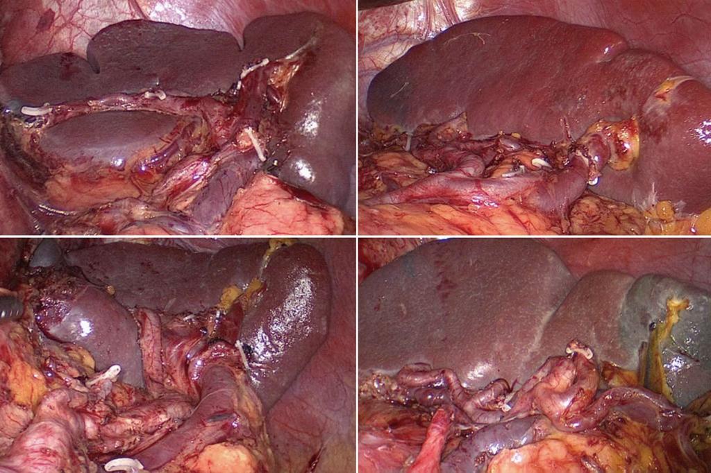 SpA (1: Preoperative assessment using 3DCT images; 2: Operative view after the completion of the splenic LN dissection).