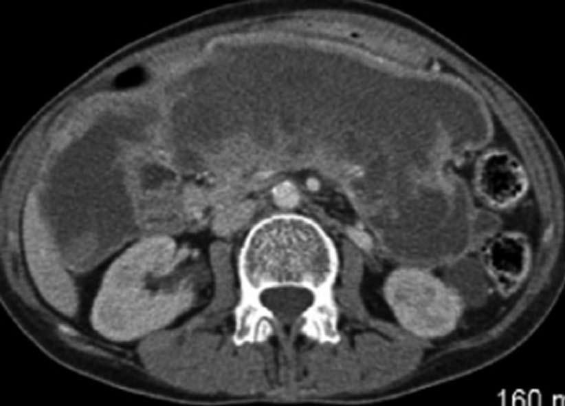 Akpinar B et al. Cystic pancreatic lesion from osteosarcoma metastasis A B C Figure 3 Post-contrast venous phase abdominal computed tomography.