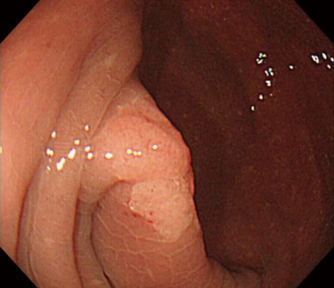 Nemoto Y et al. Appendicitis after endoscopic mucosal resection A B C D Figure 1 Endoscopic views.