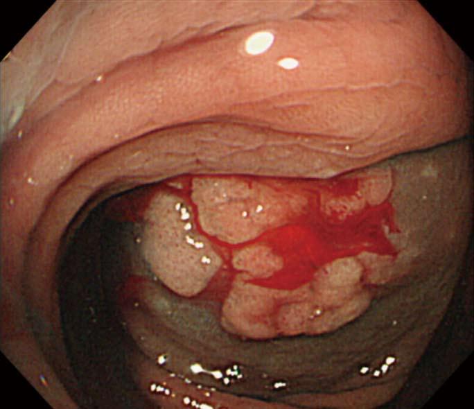 The tumor was estimated to be 15 -mm in diameter; b: After an injection of glycerol into the submucosal layer, the tumor nearly obstructed the orifice of the appendix; c: Ulcer appearance after