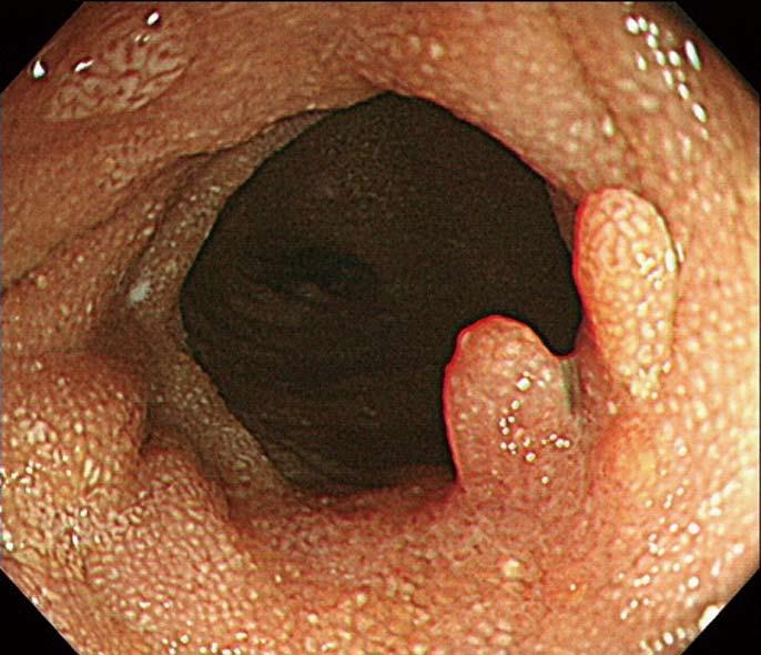 Lee SJ et al. Primary intestinal lymphangiectasia with generalized warts Figure 4 Capsule endoscopic finding.