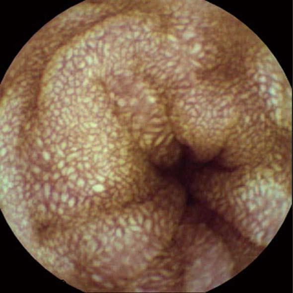 Figure 2 Abdominopelvic computerized tomography showing diffuse mucosal thickening and enhancement throughout the small bowel. Figure 3 Colonoscopic finding.