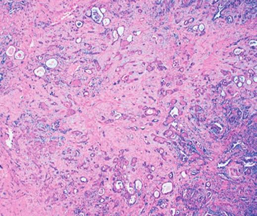 Anatomic Pathology / Original Article Table 1 Clinical Features of Three Patients With Microcystic Squamous Cell Carcinoma of the Lung Case No.