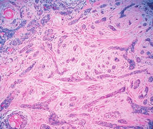 Weissferdt and Moran / Microcystic SCC of the Lung A B Image 7 A and B, Microcystic adnexal carcinoma of the skin showing microcystic duct-like structures, abortive follicles, and horn cysts in a