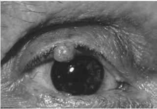 common sites: neck axilla eyelids Squamous