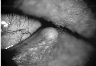 Eyelid Molluscum Contagiosum conjunctivitis follicular SPK injection