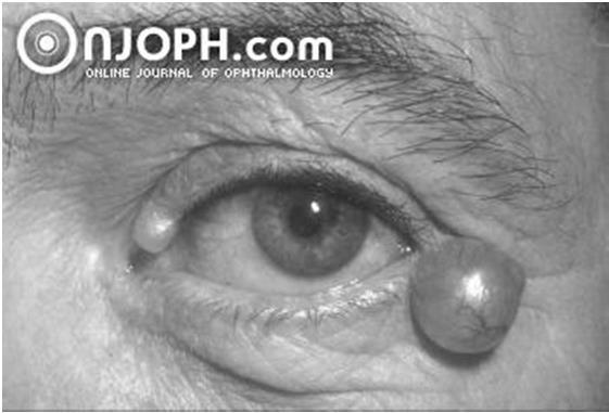 common in elderly remove for cosmetic reasons remove by total