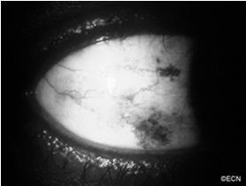 Congenital pigment flecks usually near limbus Primary Acquired if unilateral