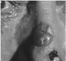 elevated aggressive more than meets the eye excision BCC: Management cryotherapy /