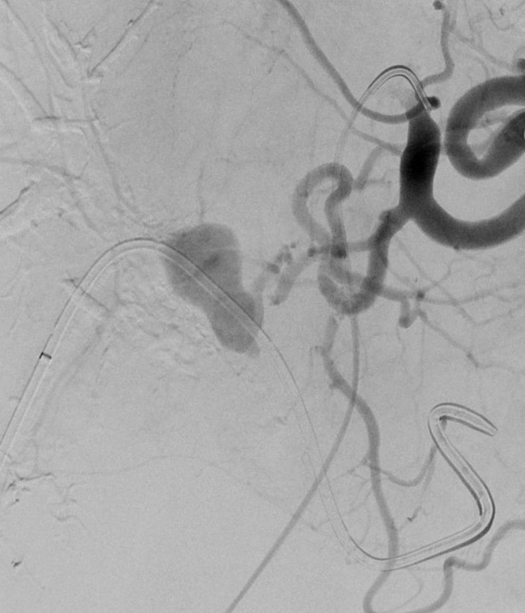 Fig. 7: Angiography reveals a large pseudoaneurysm of rt.