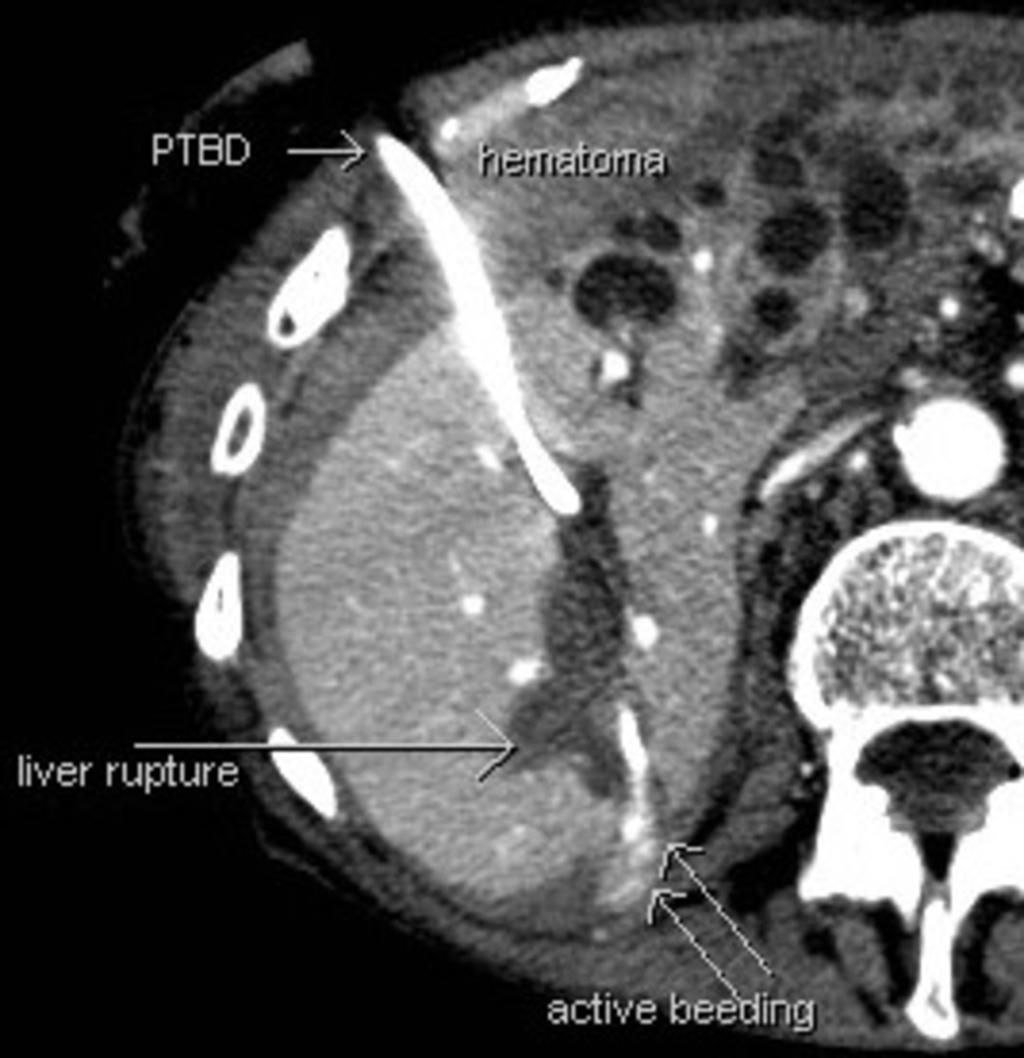 Fig. 2: Liver fracture in relation to the PTBD