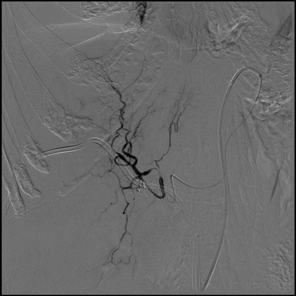 Fig. 3: No active arterial bleeding is noted at angiography
