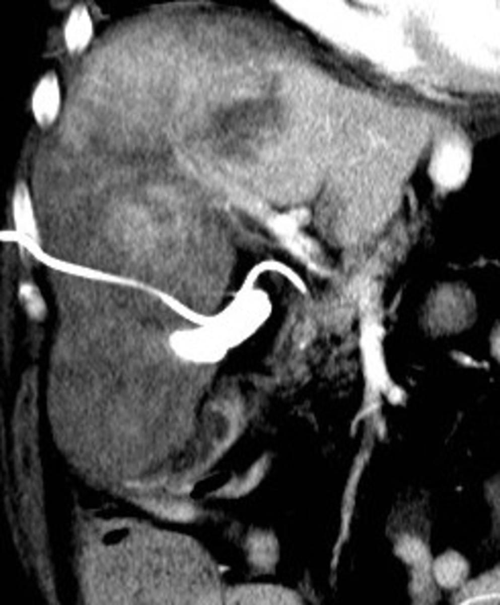 Fig. 5: Large intrahepatic hematoma is seen.