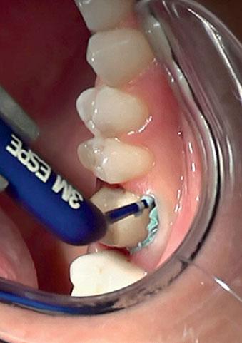 Now the innovative retraction paste sets another milestone: it is a simple and effective means of gingival retraction.