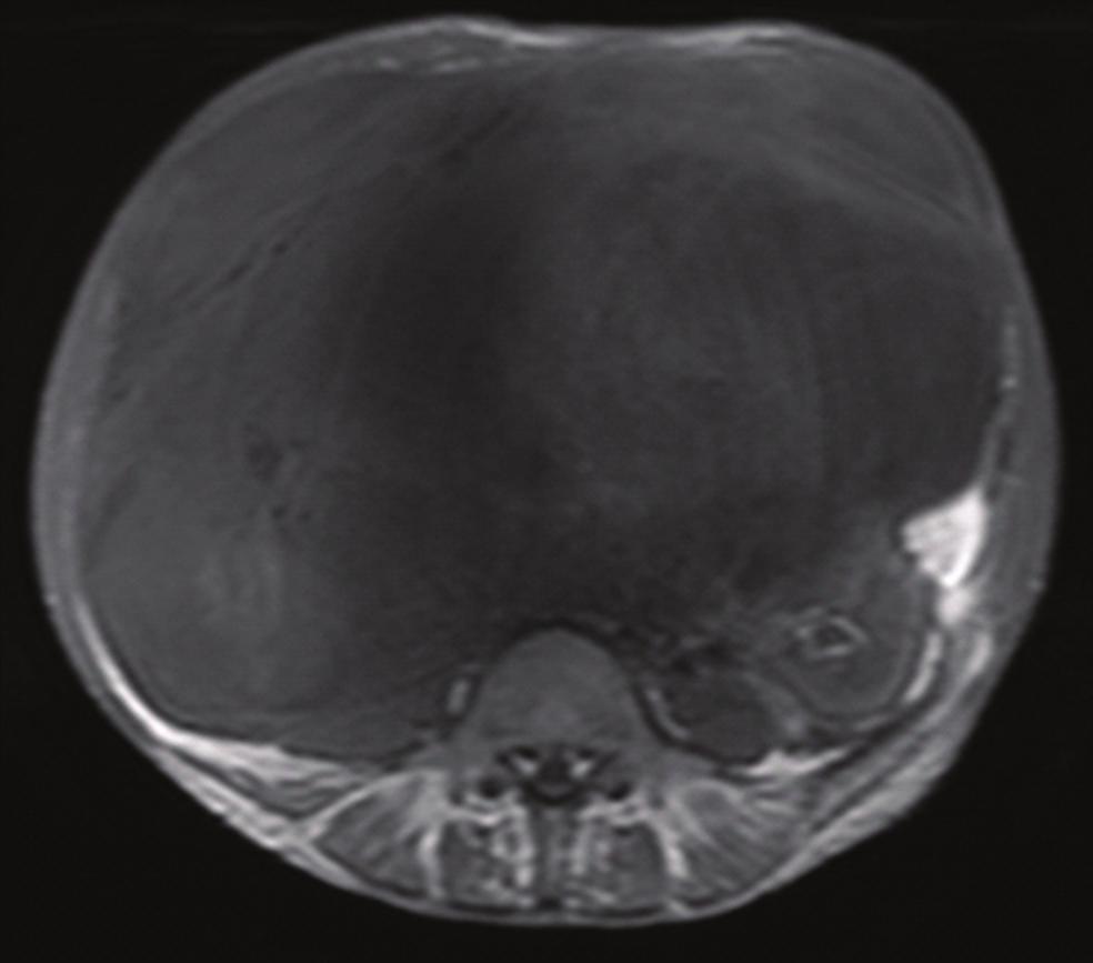 2 (c) Figure 1: shows T1-weighted images, shows T2-weighted images, and (c) shows T1-weighted and fat suppression images on MRI.